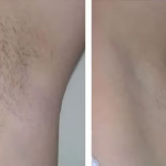 GlowSkins™ IPL Laser Permanent Hair Removal