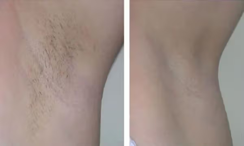 Click to view full screen GlowSilk™ IPL Laser Hair Removal Handset photo review