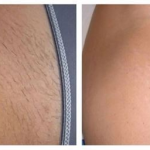 GlowSkins™ IPL Laser Permanent Hair Removal