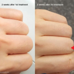 GlowSkins™ IPL Laser Permanent Hair Removal