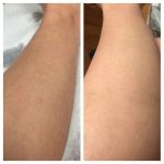 GlowSkins™ IPL Laser Permanent Hair Removal