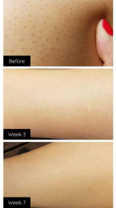 GlowSilk™ IPL Laser Hair Removal Handset photo review